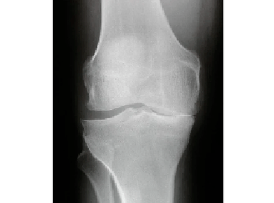 Diagnóstico de la artrosis de la articulación de la rodilla