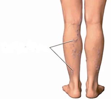Las consecuencias de la osteoartritis de rodilla