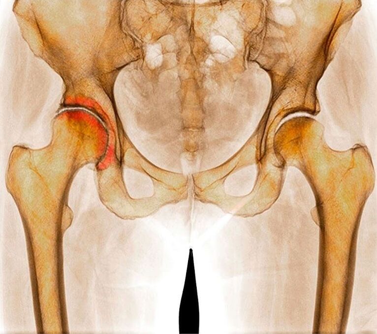 Artrosis de la articulación de la cadera