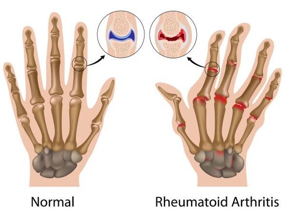 Articulaciones de los dedos sin patología y con artritis reumatoide