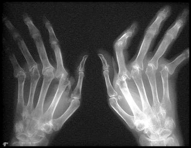 X -RAYA IMAGEN DE LAS MANOS AFECTADAS POR OSTEOARTRITIS