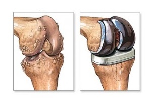 Reemplazo de rodilla para la osteoartritis