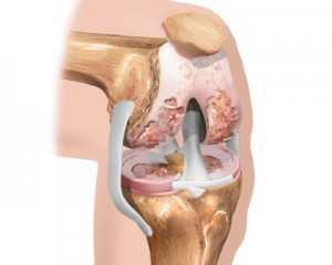 la etapa inicial de la osteoartritis de rodilla