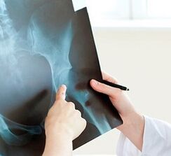Cómo tratar la artrosis de la articulación de la cadera
