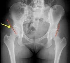 Métodos para el tratamiento de la osteoartritis de la articulación de la cadera