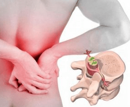 Lumbago al comienzo de la osteocondrosis de la enfermedad
