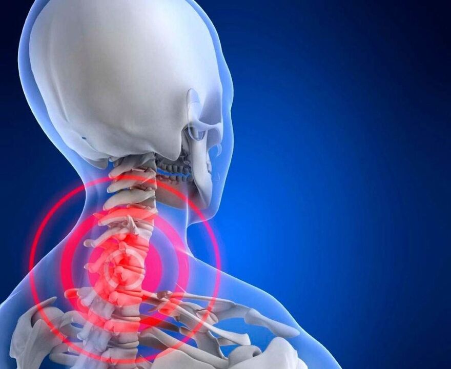 Dolor de cuello con osteocondrosis cervical