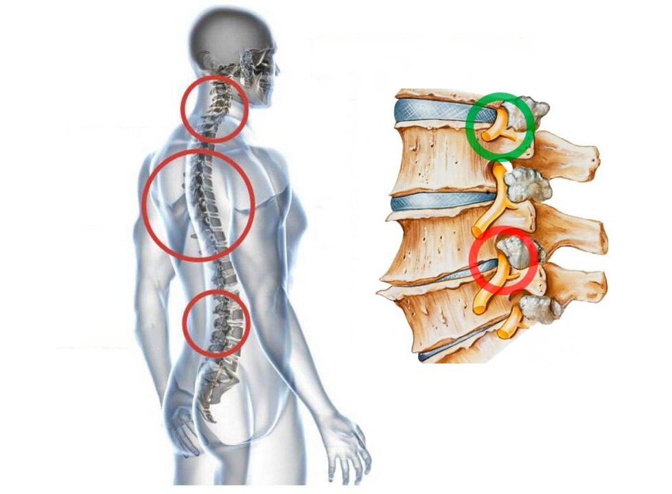 ¿Cómo se ve la osteocondrosis cervical como las vértebras