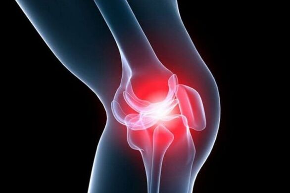 Osteoartritis de la articulación de la rodilla.