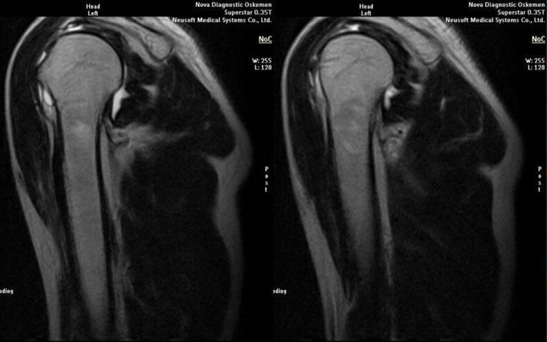Osteoartritis de la articulación del hombro en radiografía