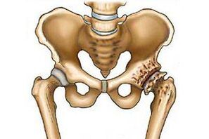 Destrucción de la articulación de la cadera en la artrosis