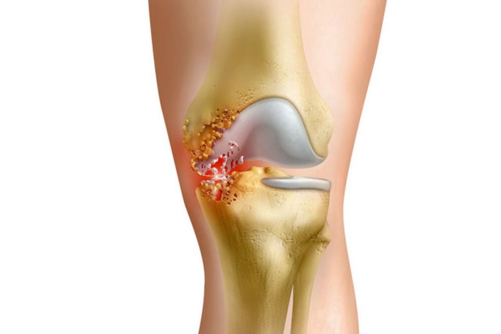 La inflamación como causa del dolor en las articulaciones de la cadera