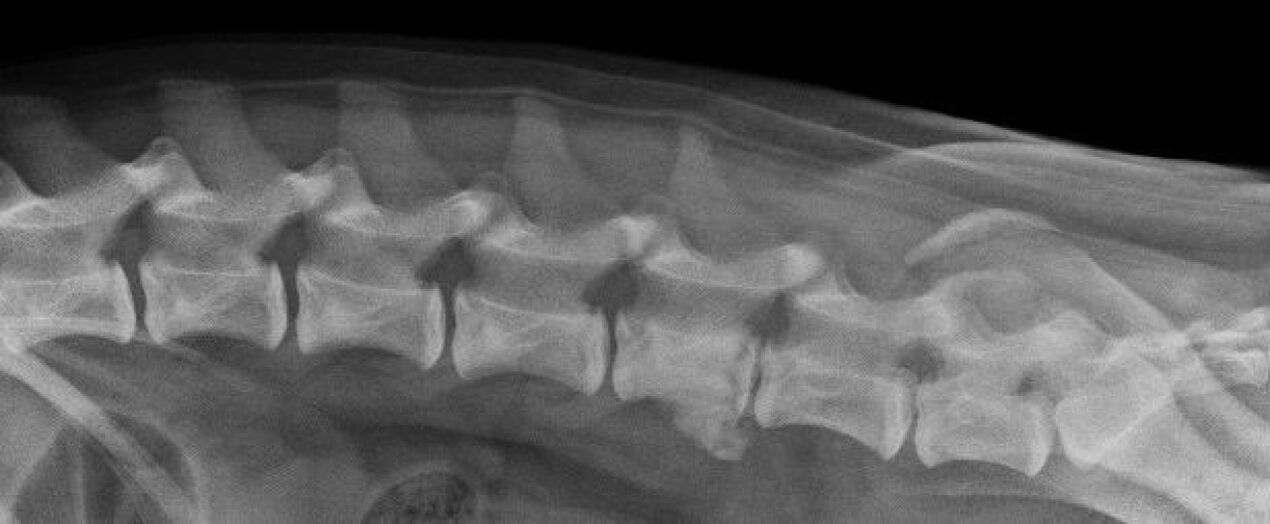 Manifestaciones de osteocondrosis de la columna torácica en radiografía. 