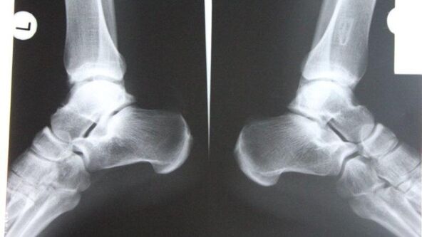 Diagnóstico de la artrosis de tobillo mediante rayos X. 