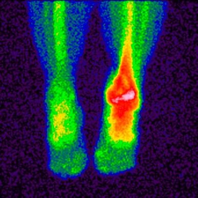 El método de diagnóstico diferencial de la artrosis cruzada es la gammagrafía. 