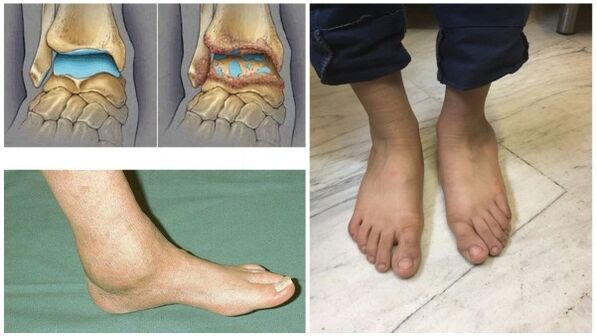 Hinchazón y deformación de la articulación del tobillo debido a la osteoartritis. 