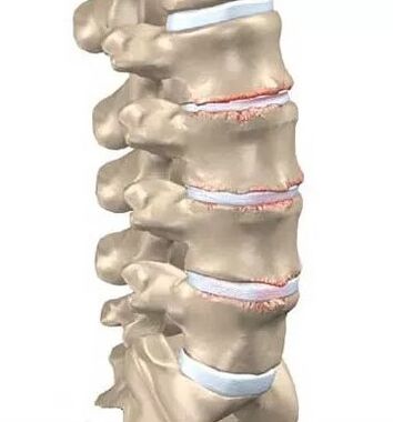 Osteocondrosis